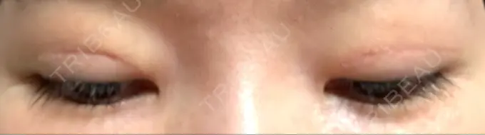 二重切開 / 眼瞼下垂（切開） / 目元修正 城本クリニック 姫路院 DAY 135 メイン用