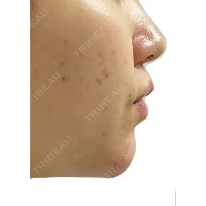 ピーリング（ニキビ・毛穴） / イオン導入 KM新宿クリニック DAY 8 メイン用