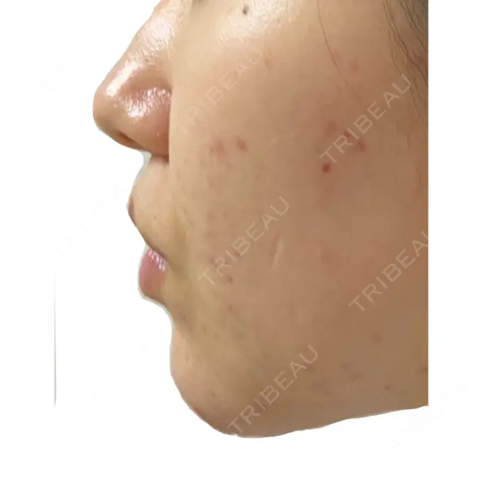 ピーリング（ニキビ・毛穴） / イオン導入 KM新宿クリニック DAY 8 メイン用