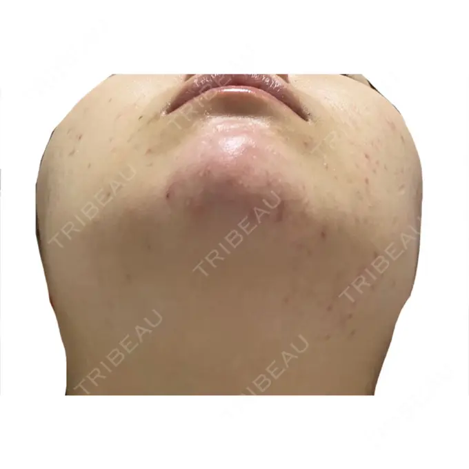 ピーリング（ニキビ・毛穴） / イオン導入 KM新宿クリニック DAY 8 メイン用