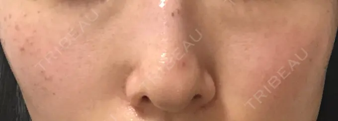 ピコスポット LOUIS CLINIC 二子玉川院【ルイクリニック】 DAY 6 メイン用