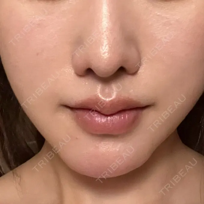 脂肪溶解注射（顔） 東京たかはしクリニック 練馬院 AFTER メイン用