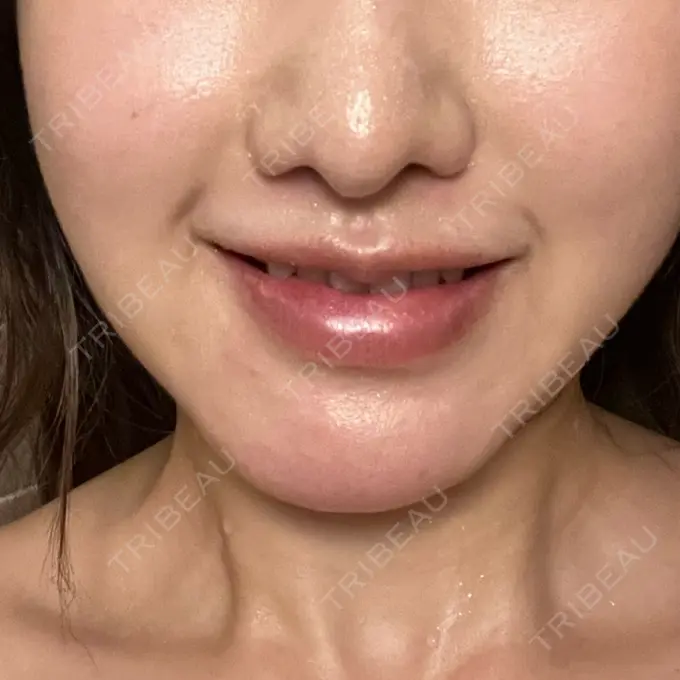 脂肪溶解注射（顔） 東京たかはしクリニック 練馬院 DAY 43 メイン用