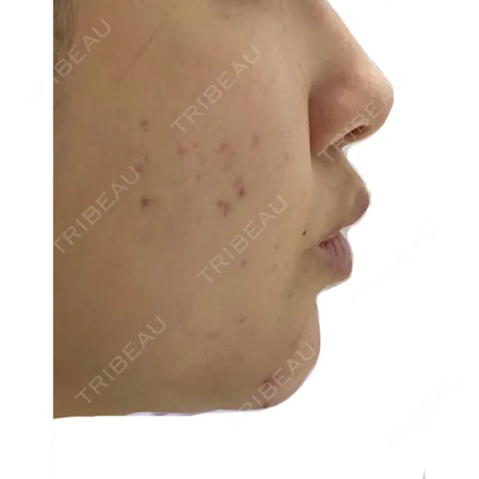 ピーリング（ニキビ・毛穴） / イオン導入 KM新宿クリニック DAY 9 メイン用