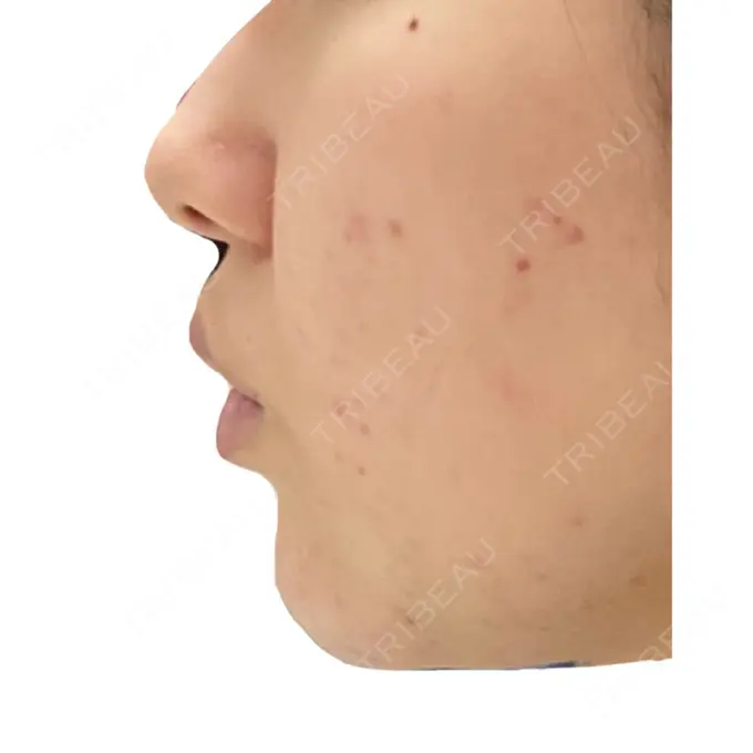 ピーリング（ニキビ・毛穴） / イオン導入 KM新宿クリニック DAY 9 メイン用