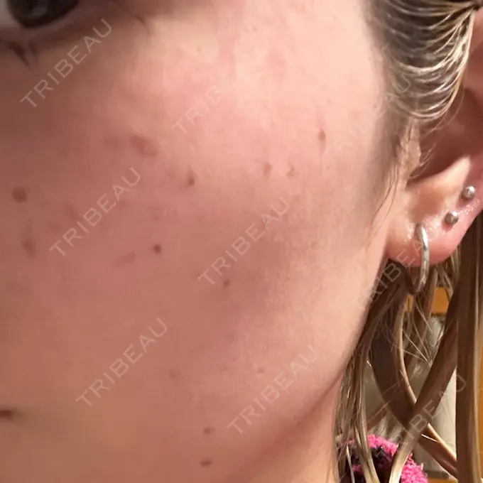 ヒアルロン酸注入（頬） / ヒアルロン酸注入（こめかみ） / ピコスポット LOUIS CLINIC 二子玉川院【ルイクリニック】 DAY 3 メイン用