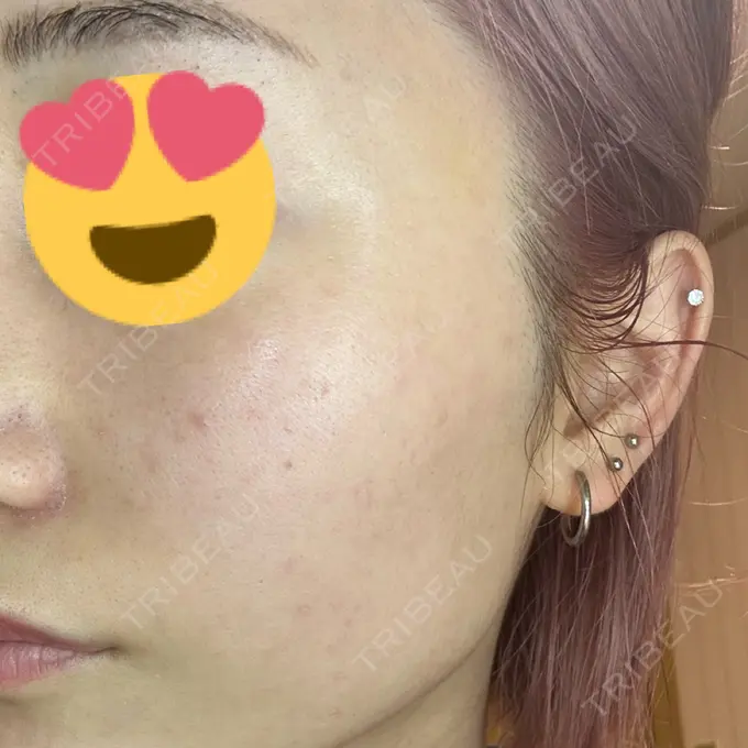 ヒアルロン酸注入（頬） / ヒアルロン酸注入（こめかみ） / ピコスポット LOUIS CLINIC 二子玉川院【ルイクリニック】 DAY 5 メイン用