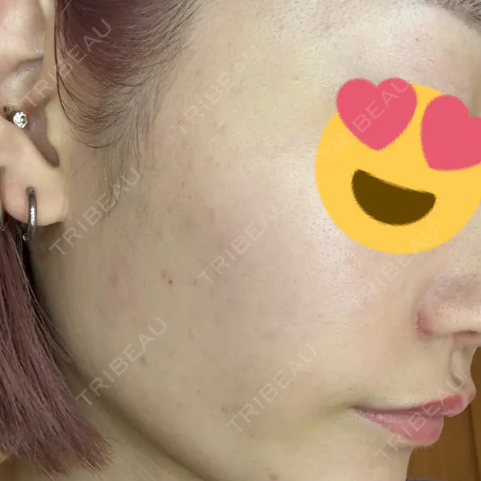 ヒアルロン酸注入（頬） / ヒアルロン酸注入（こめかみ） / ピコスポット LOUIS CLINIC 二子玉川院【ルイクリニック】 DAY 5 メイン用