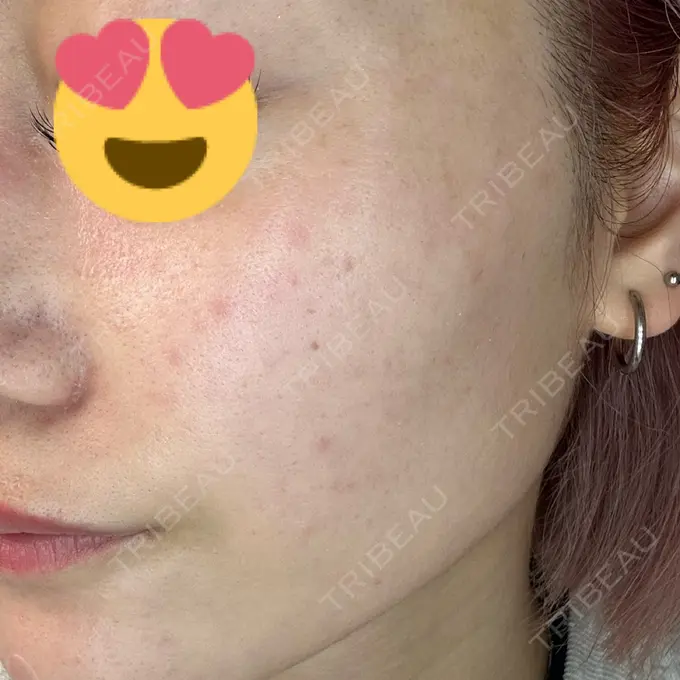 ヒアルロン酸注入（頬） / ヒアルロン酸注入（こめかみ） / ピコスポット LOUIS CLINIC 二子玉川院【ルイクリニック】 DAY 7 メイン用