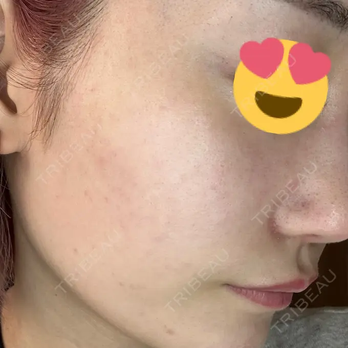 ヒアルロン酸注入（頬） / ヒアルロン酸注入（こめかみ） / ピコスポット LOUIS CLINIC 二子玉川院【ルイクリニック】 DAY 7 メイン用