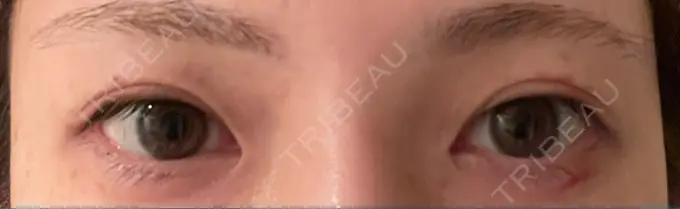 二重切開 有楽町高野美容クリニック DAY 18 メイン用