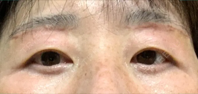 眉下切開 みずほクリニック DAY 30 メイン用