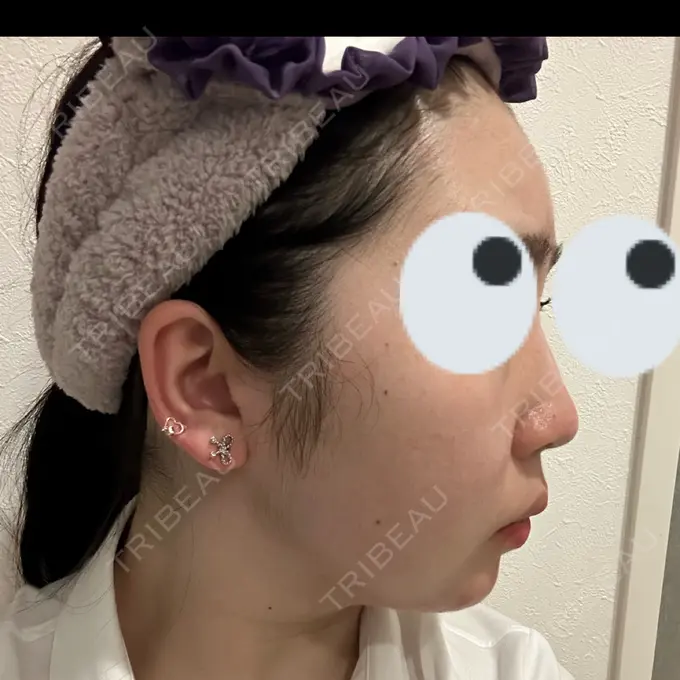 ヒアルロン酸注入（鼻） プライベートスキンクリニック 梅田本院 AFTER メイン用