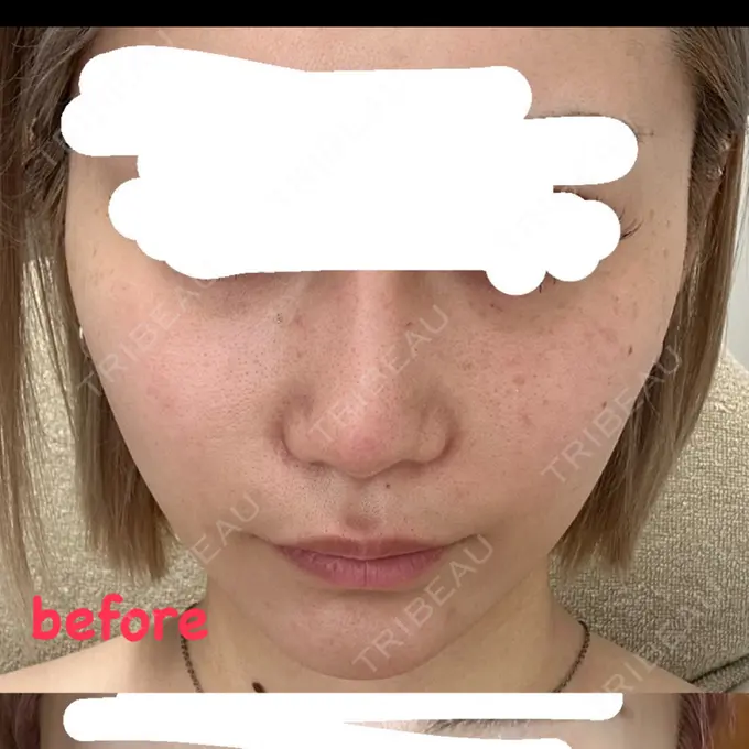 ヒアルロン酸注入（頬） / ヒアルロン酸注入（こめかみ） / ピコスポット LOUIS CLINIC 二子玉川院【ルイクリニック】 AFTER メイン用