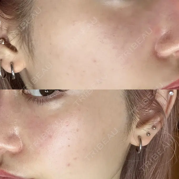 ヒアルロン酸注入（頬） / ヒアルロン酸注入（こめかみ） / ピコスポット LOUIS CLINIC 二子玉川院【ルイクリニック】 DAY 8 メイン用