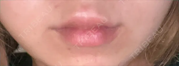 ボトックス（口角） みずほクリニック AFTER メイン用