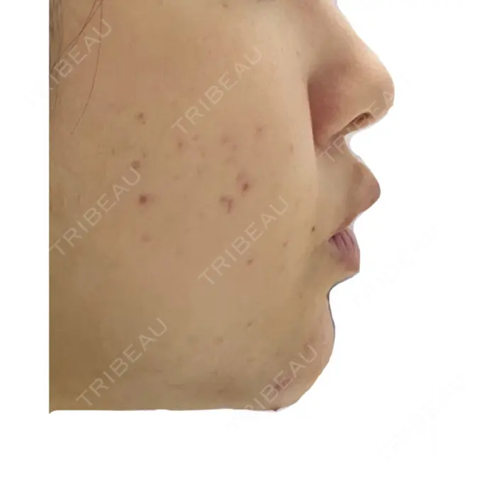 ピーリング（ニキビ・毛穴） / イオン導入 KM新宿クリニック AFTER メイン用