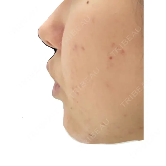 ピーリング（ニキビ・毛穴） / イオン導入 KM新宿クリニック DAY 10 メイン用