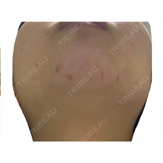 ピーリング（ニキビ・毛穴） / イオン導入 KM新宿クリニック DAY 10 メイン用