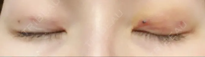 二重埋没 グローバルビューティークリニック 東京院 DAY 4 メイン用