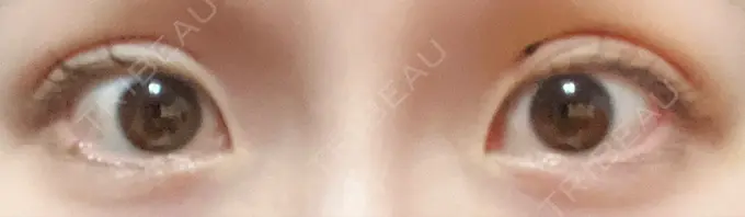 二重埋没 グローバルビューティークリニック 東京院 DAY 4 メイン用