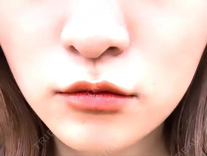 ボトックス（エラ・小顔） / ハイフ（顔） TCB東京中央美容外科 六本木院 DAY 19 メイン用