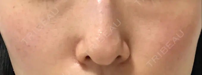 ピコスポット LOUIS CLINIC 二子玉川院【ルイクリニック】 AFTER メイン用