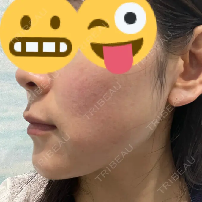 ピコレーザートーニング（美白・肝斑） アモーレクリニック 名古屋院 DAY 1 メイン用