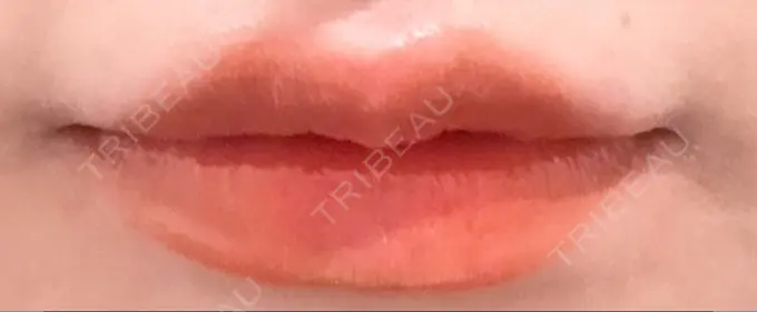 ボトックス（口角） Mavie Beauty Clinic （マヴィービューティークリニック） DAY 1 メイン用