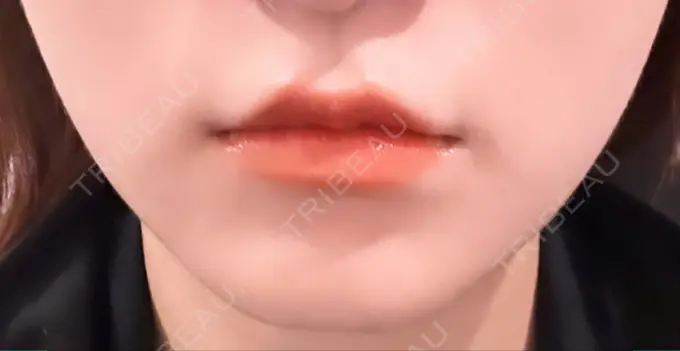 ボトックス（エラ・小顔） / ハイフ（顔） TCB東京中央美容外科 六本木院 AFTER メイン用