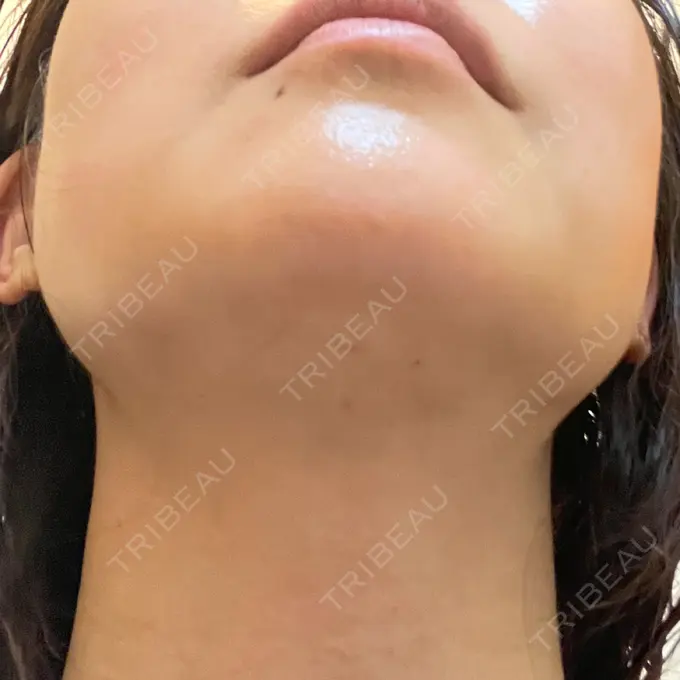 糸リフト / 脂肪吸引（顔） 湘南美容クリニック 岡山院 DAY 17 メイン用