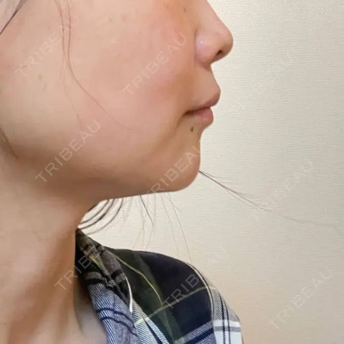 糸リフト / 脂肪吸引（顔） 湘南美容クリニック 岡山院 DAY 17 メイン用