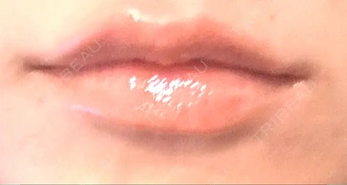 ボトックス（口角） Mavie Beauty Clinic （マヴィービューティークリニック） DAY 2 メイン用