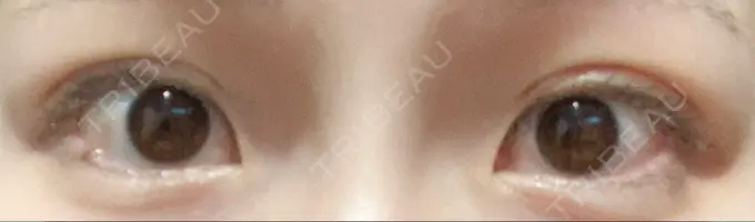 二重埋没 グローバルビューティークリニック 東京院 DAY 5 メイン用