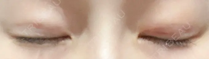 二重埋没 グローバルビューティークリニック 東京院 DAY 5 メイン用