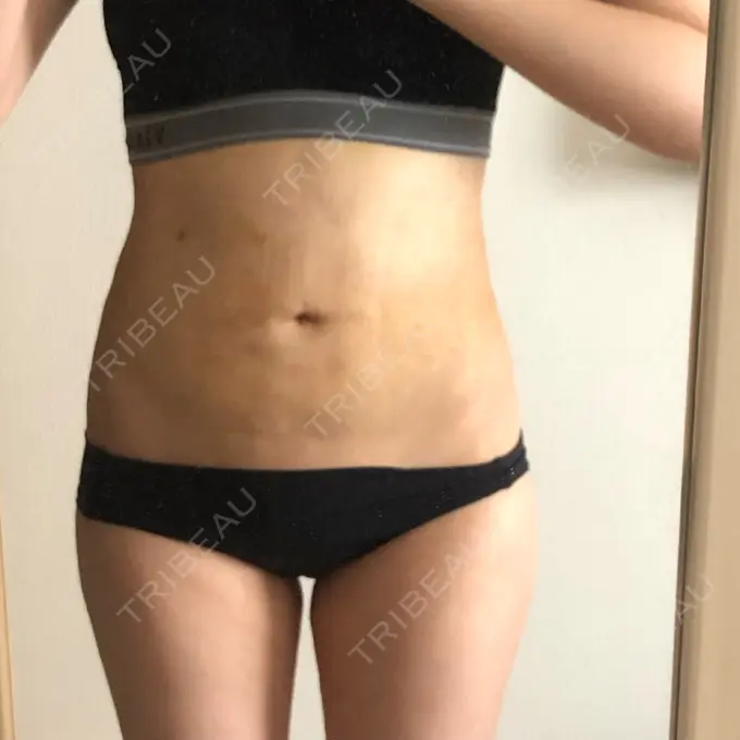 脂肪吸引（お腹） / 脂肪吸引（腰） GAYA body design clinic DAY 9 メイン用