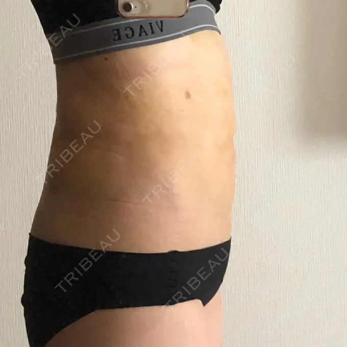 脂肪吸引（お腹） / 脂肪吸引（腰） GAYA body design clinic DAY 9 メイン用