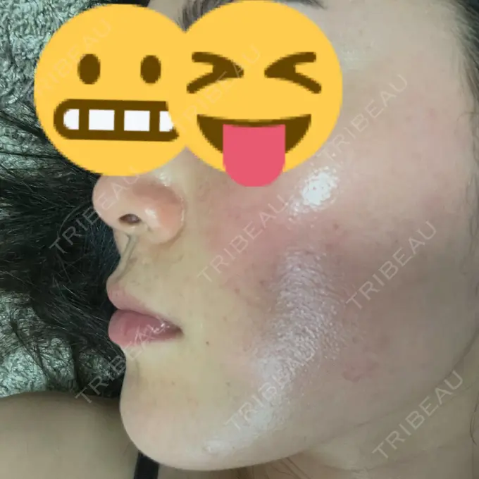 ピコレーザートーニング（美白・肝斑） アモーレクリニック 名古屋院 DAY 3 メイン用