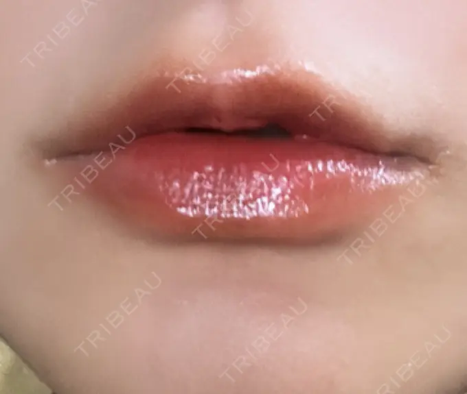 ボトックス（口角） Mavie Beauty Clinic （マヴィービューティークリニック） DAY 3 メイン用