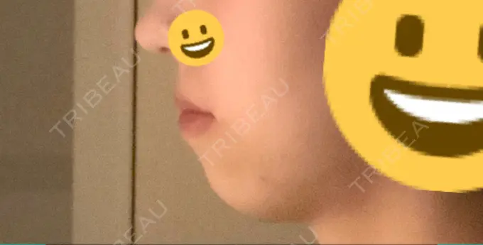 ボトックス（あご） / ヒアルロン酸注入（あご） 東京形成美容外科 船橋院 AFTER メイン用