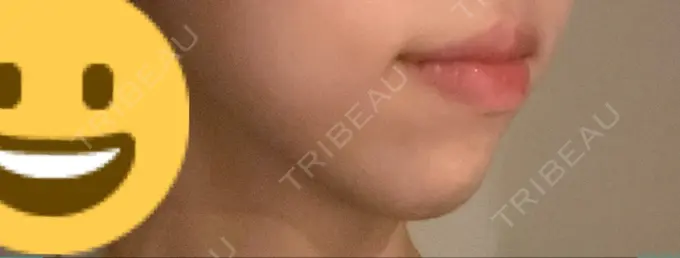 ボトックス（あご） / ヒアルロン酸注入（あご） 東京形成美容外科 船橋院 DAY 59 メイン用