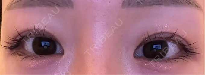 ボトックス（タレ目） ルラ美容クリニック 渋谷本院 DAY 3 メイン用