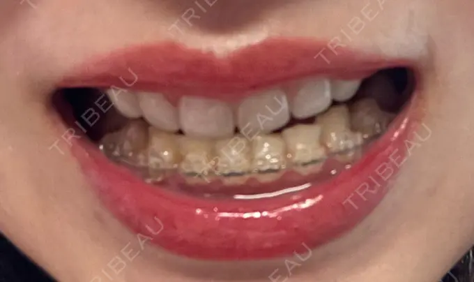 ガミースマイル手術 / 矯正（ワイヤー） / セラミック / その他（審美歯科/矯正歯科） 東京銀座A CLINIC デンタル DAY 226 メイン用