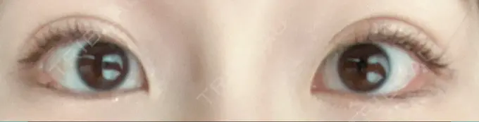 二重埋没 グローバルビューティークリニック 東京院 DAY 6 メイン用