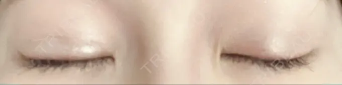 二重埋没 グローバルビューティークリニック 東京院 DAY 6 メイン用