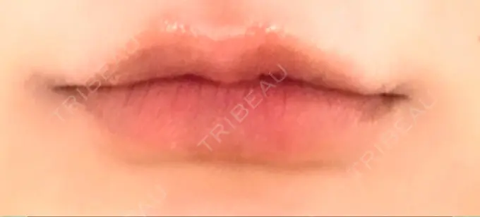 ボトックス（口角） Mavie Beauty Clinic （マヴィービューティークリニック） DAY 3 メイン用