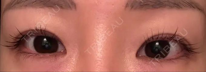 ボトックス（タレ目） ルラ美容クリニック 渋谷本院 DAY 4 メイン用