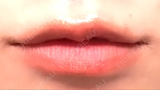 ボトックス（口角） Mavie Beauty Clinic （マヴィービューティークリニック） DAY 4 メイン用