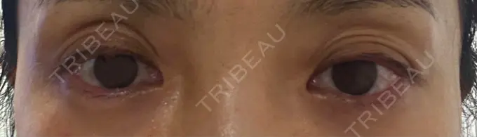 その他（目元） みずほクリニック DAY 4 メイン用