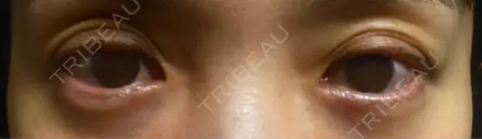 その他（目元） みずほクリニック DAY 8 メイン用